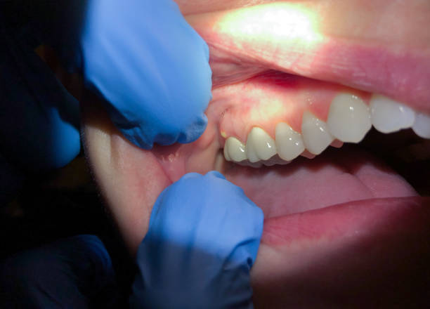 Best Emergency Treatment for Dental Infections or Abscesses in La Mesa, CA