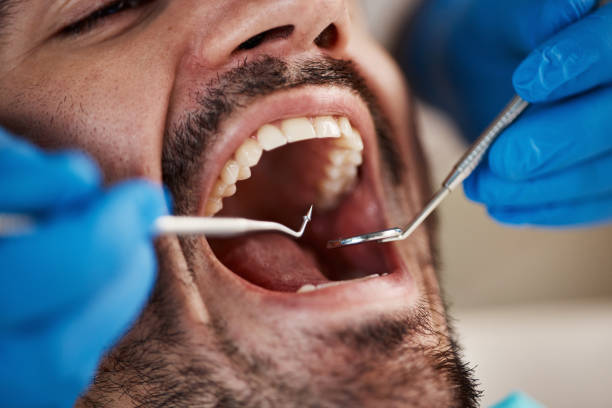 Best Emergency Dental Care for Broken or Chipped Teeth in La Mesa, CA